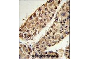 Formalin-fixed and paraffin-embedded human hepatocarcinoma reacted with ITIH2 Antibody (C-term), which was peroxidase-conjugated to the secondary antibody, followed by DAB staining.