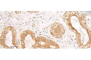 Immunohistochemistry of paraffin-embedded Human breast cancer tissue using ORC4 Polyclonal Antibody at dilution of 1:80(x200) (ORC4 antibody)