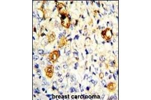 Formalin-fixed and paraffin-embedded human breast carcinoma with P19 Antibody (C-term), which was peroxidase-conjugated to the secondary antibody, followed by DAB staining. (MMP19 antibody  (C-Term))