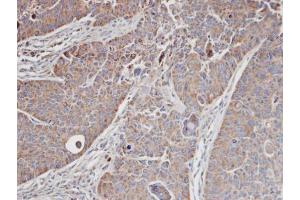 IHC-P Image Immunohistochemical analysis of paraffin-embedded SW480 xenograft, using MRCK alpha, antibody at 1:100 dilution. (CDC42BPA antibody)