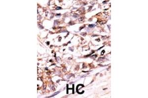 Formalin-fixed and paraffin-embedded human cancer tissue reacted with the primary antibody, which was peroxidase-conjugated to the secondary antibody, followed by AEC staining. (DUSP13-M1 (AA 1-30), (N-Term) antibody)