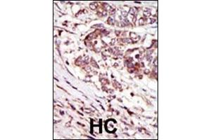 Formalin-fixed and paraffin-embedded human cancer tissue reacted with the primary antibody, which was peroxidase-conjugated to the secondary antibody, followed by AEC staining. (CAMK1G antibody  (C-Term))