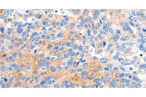 Immunohistochemistry of paraffin-embedded Human ovarian cancer tissue using HCN2 Polyclonal Antibody at dilution 1:80 (HCN2 antibody)