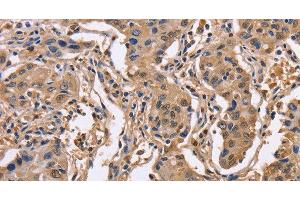 Immunohistochemistry of paraffin-embedded Human lung cancer using IDH1 Polyclonal Antibody at dilution of 1:50