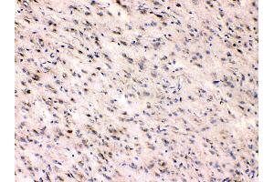 Beta III Tubulin was detected in paraffin-embedded sections of human glioma tissues using rabbit anti- Beta III Tubulin Antigen Affinity purified polyclonal antibody (Catalog # ) at 1 µg/mL. (TUBB3 antibody  (C-Term))