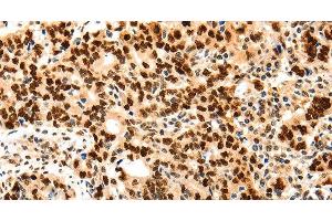 Immunohistochemistry of paraffin-embedded Human gastic cancer using Proliferating Cell Nuclear Antigen Polyclonal Antibody at dilution of 1:44 (PCNA antibody)
