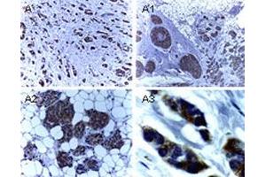 Immunohistochemical analysis of BIRC4 in formalin-fixed, paraffin-embedded human breast carcinoma. (XIAP antibody)