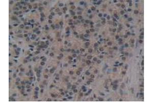 IHC-P analysis of Human Prostate Gland Cancer Tissue, with DAB staining. (ATG7 antibody  (AA 429-488))