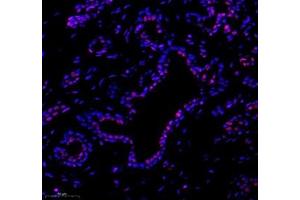 Immunofluorescence of paraffin embedded human breast cancer using tfiib (ABIN7074034) at dilution of 1: 500 (300x lens)