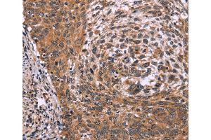Immunohistochemistry of Human colon cancer using ING2 Polyclonal Antibody at dilution of 1:60 (ING2 antibody)