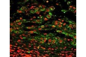 Immunofluorescence analysis of CD11c antibody with paraffin-embedded human hepatocarcinoma. (CD11c antibody  (AA 1119-1145))