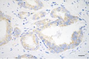 Immunohistochemistry was performed on paraffin-embedded human prostatic adenocarcinoma using collagen III alpha 1 antibody (ABIN7798125), 1:200).