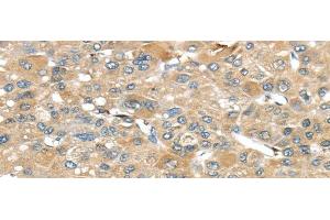 Immunohistochemistry of paraffin-embedded Human liver cancer tissue using SRP54 Polyclonal Antibody at dilution 1:45 (SRP54 antibody)