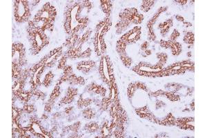 IHC-P Image Immunohistochemical analysis of paraffin-embedded human breast cancer, using IL3 Receptor alpha, antibody at 1:250 dilution. (IL3RA antibody)