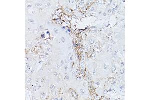 Immunohistochemistry of paraffin-embedded human esophageal cancer using GN Rabbit pAb (ABIN3023414, ABIN3023415, ABIN3023416 and ABIN6219781) at dilution of 1:150 (40x lens). (GNA11 antibody)