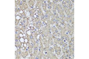 Immunohistochemistry of paraffin-embedded human liver injury using PIK3C2A antibody at dilution of 1:100 (x40 lens). (PIK3C2A antibody)