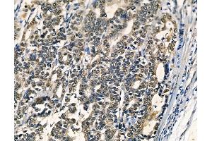 ABIN6262948 and ABIN6278588 at 1/100 staining human pancreatic cancer by IHC-P. (GAL4 antibody  (N-Term))