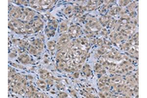 The image on the left is immunohistochemistry of paraffin-embedded Human thyroid cancer tissue using ABIN7129455(FAR2 Antibody) at dilution 1/50, on the right is treated with fusion protein. (FAR2 antibody)