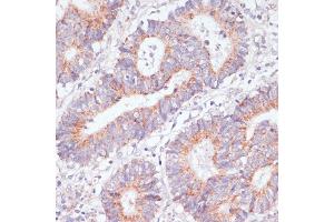 Immunohistochemistry of paraffin-embedded human liver cancer using Rap1A antibody (ABIN3021199, ABIN3021200, ABIN3021201 and ABIN6214062) at dilution of 1:100 (40x lens).