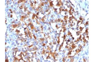 Formalin-fixed, paraffin-embedded human Melanoma stained with MART-1 Rabbit Polyclonal Antibody. (MLANA antibody)