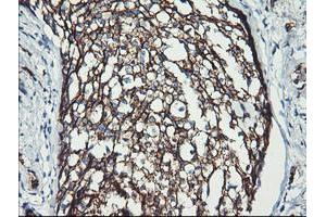 Immunohistochemical staining of paraffin-embedded Adenocarcinoma of Human breast tissue using anti-ERBB2 mouse monoclonal antibody. (ErbB2/Her2 antibody  (AA 676-1255))