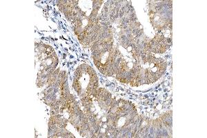 Immunohistochemistry of paraffin-embedded human colon carcinoma using SRP72 Rabbit pAb (ABIN6134166, ABIN6148452, ABIN7101299 and ABIN7101300) at dilution of 1:100 (40x lens). (SRP72 antibody)