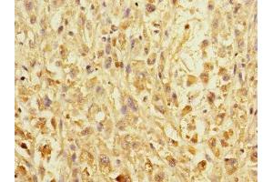 Immunohistochemistry of paraffin-embedded human melanoma using ABIN7151990 at dilution of 1:100 (ERBB2IP antibody  (AA 1193-1412))