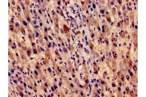 Immunocytochemistry analysis of human liver cancer using ABIN7151520 at dilution of 1:100 (EVC antibody  (AA 493-602))