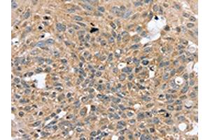 The image on the left is immunohistochemistry of paraffin-embedded Human breast cancer tissue using ABIN7130823(RASGEF1A Antibody) at dilution 1/20, on the right is treated with fusion protein. (RASGEF1A antibody)