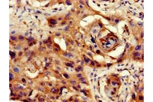 Immunohistochemistry of paraffin-embedded human cervical cancer using ABIN7169308 at dilution of 1:100 (PPP1CB antibody  (Catalytic Subunit))