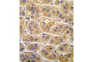 Formalin-fixed and paraffin-embedded human hepatocarcinoma tissue reacted with AGT antibody (C-term), which was peroxidase-conjugated to the secondary antibody, followed by DAB staining. (AGT antibody  (C-Term))