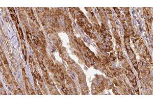 ABIN6267124 at 1/100 staining Human thyroid cancer tissue by IHC-P. (LIPE antibody  (pSer563))