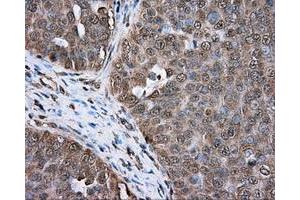 Immunohistochemical staining of paraffin-embedded colon tissue using anti-ERCC1 mouse monoclonal antibody. (ERCC1 antibody)