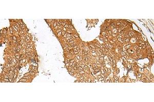 Immunohistochemistry of paraffin-embedded Human colorectal cancer tissue using ZBTB8A Polyclonal Antibody at dilution of 1:100(x200) (ZBTB8A antibody)