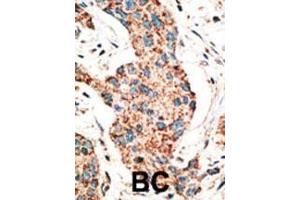 Formalin-fixed and paraffin-embedded human cancer tissue reacted with the primary antibody, which was peroxidase-conjugated to the secondary antibody, followed by AEC staining. (RAD9A antibody  (AA 1-30))