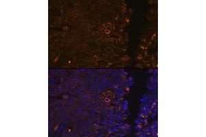 Immunofluorescence analysis of human cervix cancer using Cytokeratin 13 (KRT13) (KRT13) Rabbit mAb (ABIN7268089) at dilution of 1:100 (40x lens). (Cytokeratin 13 antibody)