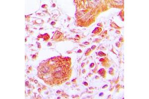 Immunohistochemical analysis of PLC gamma 1 (pY783) staining in human lung cancer formalin fixed paraffin embedded tissue section. (Phospholipase C gamma 1 antibody  (pTyr783))