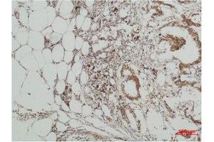Immunohistochemistry (IHC) analysis of paraffin-embedded Human Breast Carcicnoma using ERK 5 Polyclonal Antibody. (MAPK7 antibody)