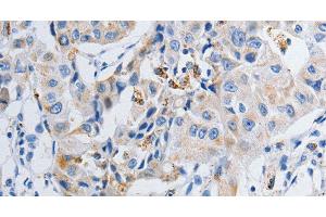 Immunohistochemistry of paraffin-embedded Human lung cancer tissue using GRIA3 Polyclonal Antibody at dilution 1:50 (Glutamate Receptor 3 antibody)