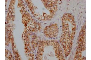 IHC image of ABIN7166043 diluted at 1:100 and staining in paraffin-embedded human prostate cancer performed on a Leica BondTM system. (S1A12 (AA 2-91) antibody)