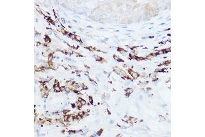 Immunohistochemistry of paraffin-embedded human breast cancer using NEDD9 Rabbit pAb (ABIN3023330, ABIN3023331, ABIN3023332 and ABIN6219606) at dilution of 1:100 (40x lens). (NEDD9 antibody  (AA 60-174))