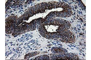 Immunohistochemical staining of paraffin-embedded Adenocarcinoma of Human endometrium tissue using anti-DTYMK mouse monoclonal antibody. (DTYMK antibody)