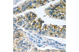 Immunohistochemical analysis of NBC1 staining in human prostate formalin fixed paraffin embedded tissue section. (SLC4A4 antibody)