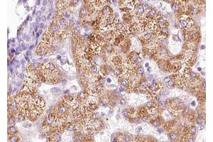 ABIN6267633 at 1/100 staining human liver carcinoma tissue sections by IHC-P.