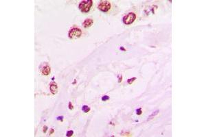 Immunohistochemical analysis of HKR1 staining in human lung cancer formalin fixed paraffin embedded tissue section. (HKR1 antibody  (Center))