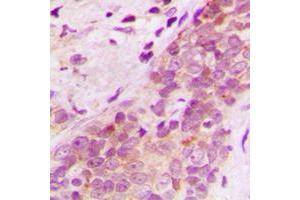 Immunohistochemical analysis of AIP-1 staining in human breast cancer formalin fixed paraffin embedded tissue section. (WDR1 antibody  (Center))