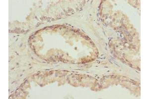 Immunohistochemistry of paraffin-embedded human prostate cancer using ABIN7173695 at dilution of 1:100 (TUBb6 antibody  (AA 1-446))