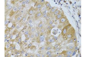 Immunohistochemistry of paraffin-embedded human breast cancer using HD antibody (ABIN6128014, ABIN6141689, ABIN6141690 and ABIN7101785) at dilution of 1:100 (40x lens). (HDAC8 antibody  (AA 1-377))