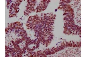 IHC image of ABIN7127813 diluted at 1:100 and staining in paraffin-embedded human ovarian cancer performed on a Leica BondTM system. (Recombinant SMC1A antibody)