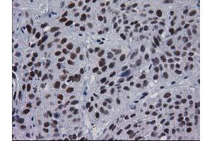Immunohistochemical staining of paraffin-embedded Carcinoma of Human bladder tissue using anti-MYD88 mouse monoclonal antibody.